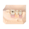 Anatomical Implant Restoration Crown